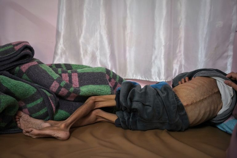 Mona al-Raqab lifts the shirt of her 5-year-old son, Osama al-Raqab, revealing signs of malnutrition and worsening cystic fibrosis, exacerbated since the start of the war by the shortage of meat, fish, and enzyme tablets needed to help him digest food, as he receives treatment at the malnutrition clinic in Nasser hospital, Khan Younis, Gaza Strip, Thursday, May 1, 2025(AP Photo/Abdel Kareem Hana)