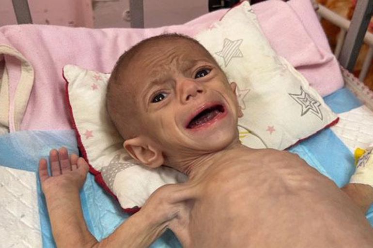 في غزة.. طفولة معذبة تحت سياط الحرب 2 **داخلية** الطفلة سوار عاشور 5 شهور تعاني من سوء التغذية نتيجة لعدم توفر الحليب وانعدام الأدوية والمدعمات اللازمة